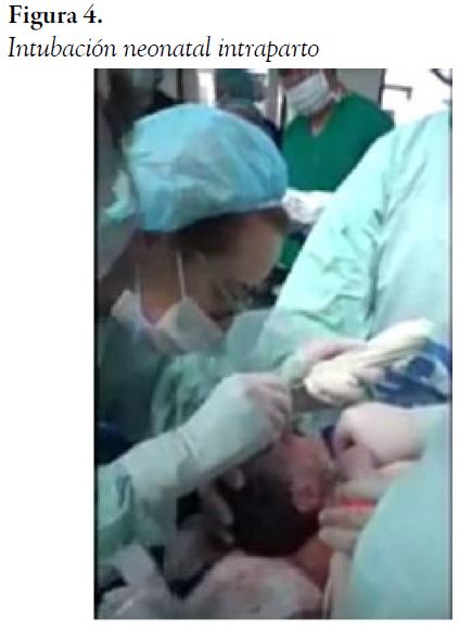  Intubaci&oacute;n neonatal intraparto