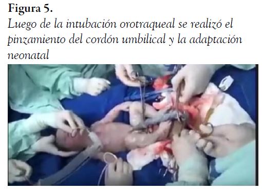 Luego de la intubaci&oacute;n orotraqueal se realiz&oacute; el pinzamiento del cord&oacute;n umbilical y la adaptaci&oacute;n neonatal