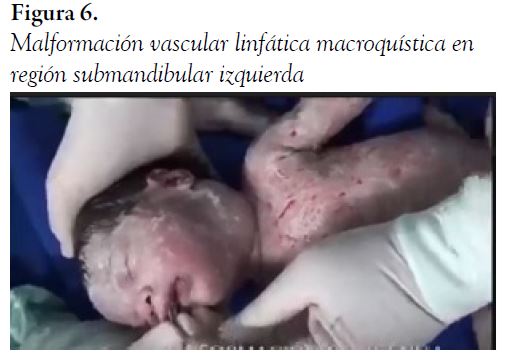 Malformaci&oacute;n vascular linf&aacute;tica macroqu&iacute;stica en regi&oacute;n submandibular izquierda