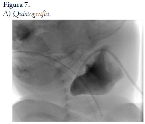 A) Quistograf&iacute;a.