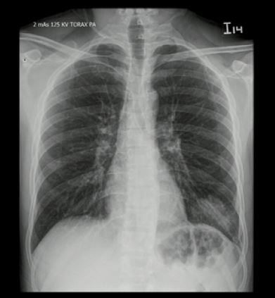  Radiografía de tórax
