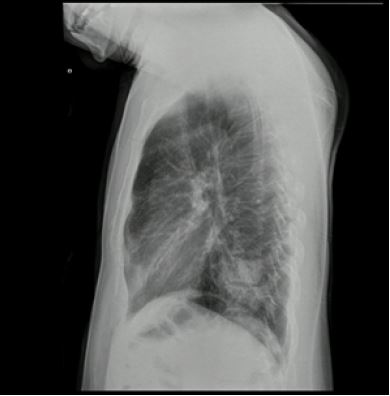 Radiografía de tórax: proyección lateral