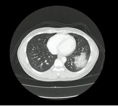 Tomografía de tórax de alta resolución