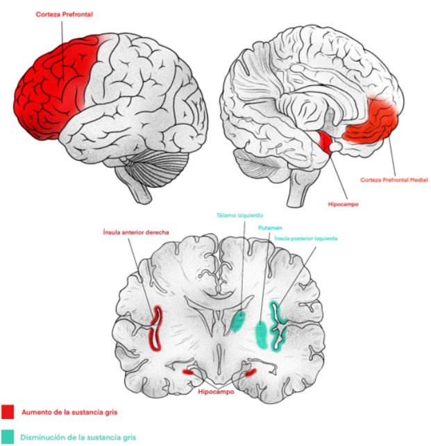 Hallazgos de cambios estructurales y volumétricos en personas meditadoras. Cambios morfológicos en regiones cerebrales de meditadores estudiados a través de neuroimagen estructural (resonancia magnética nuclear y morfometría basada en vóxeles). Las regiones en rojo corresponden a sectores cerebrales de meditadores adultos, donde se evidenció un incremento del volumen en comparación con los no meditadores. Las regiones en verde corresponden a sectores cerebrales de meditadores adolescentes, en los cuales se encontró una disminución del volumen posterior a una intervención de 12 semanas de meditación, comparado con sus propios cerebros antes de esta.