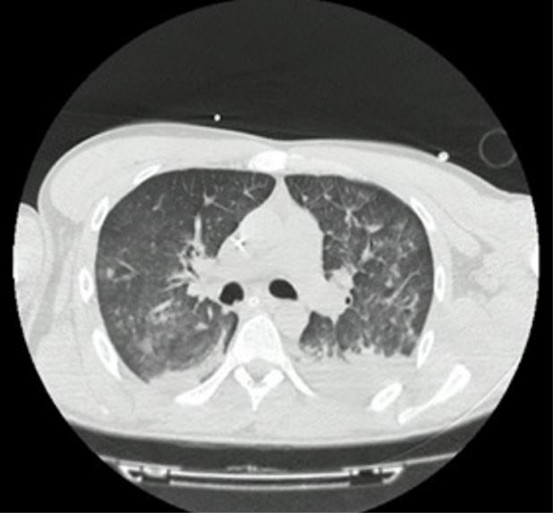 Tomograf&iacute;a de t&oacute;rax