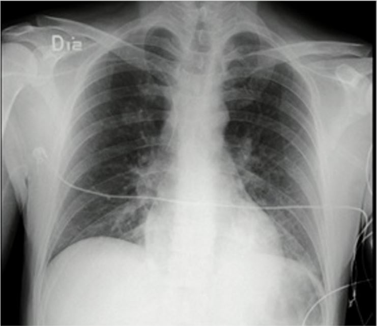 Radiograf&iacute;a de t&oacute;rax a las 72 horas despu&eacute;s del ingreso