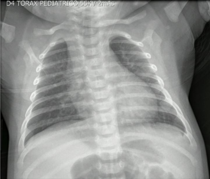 Radiograf&iacute;a de t&oacute;rax