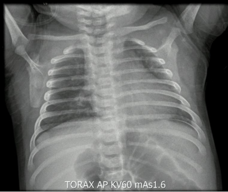 Radiograf&iacute;a de t&oacute;rax AP con opacidades intersticiales de predominio parahiliar