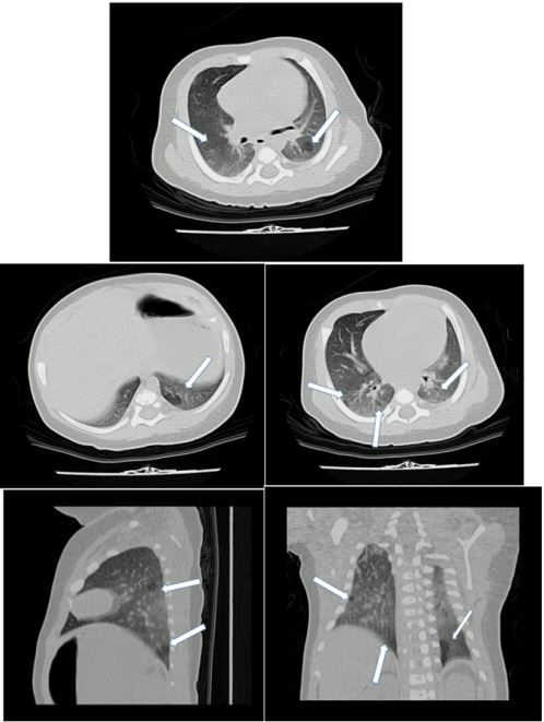 Tomograf&iacute;a de t&oacute;rax que evidencia las opacidades en vidrio esmerilado que configuraban &aacute;reas de patr&oacute;n en mosaico de atenuaci&oacute;n con &aacute;reas de atrapamiento de aire (zonas hipodensas) de predominio en los l&oacute;bulos inferiores (v&eacute;anse las flechas)