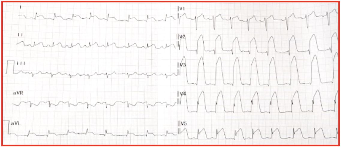 Electrocardiograma de ingreso con evidencia de elevaci&oacute;n del segmento ST en todas las derivaciones, excepto en DIII con infradesnivel de aVR