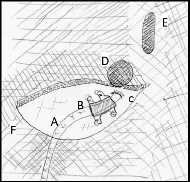 Técnica. Paso 4. Fijación del electrodo. Se observa el electrodo saliendo de su punto de entrada (punción) y el sistema plástico que permite fijar el electrodo en la fascia. Debe verificarse que el electrodo no se deslice en el fijador. A: electrodo B: Fijador de plástico. C: punto de entrada (de punción) del electrodo. D: pedículo. E: apófisis espinosa.
