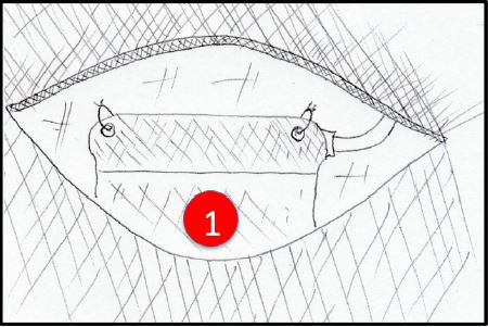 Técnica. Paso 5. Implantación del generador. Se observa incisión (única) y en su interior el generador de pulsos eléctricos. Se debe fijar en sus tres puntos específicos y verificar que el trayecto del electrodo no presentó acodaduras. 1 rojo: generador de pulso.