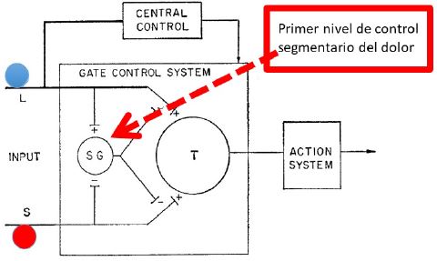 Esquema original de la teoría de la compuerta, modificado por el autor para ilustrar uno de los principios del entendimiento del dolor. La teoría de la compuerta se trata de un balance competitivo inhibitorio (azul; modificado por el autor) y excitatorio (rojo; modificado por el autor), localizado en las capas mas superficiales del cuerno posterior de la médula. Es el primer nivel de control segmentario del dolor. SG: sustancias gelatinosas de Rolando: T: células Y.