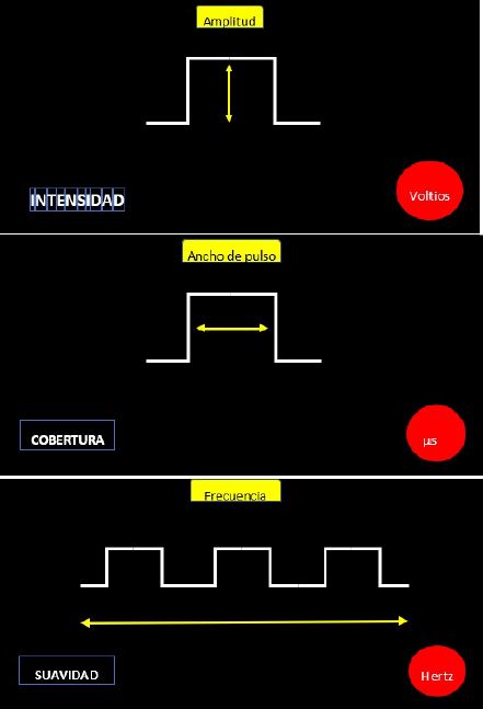 Onda eléctrica y las variaciones en evaluación (figura superior). La amplitud de la onda eléctrica se mide en voltios y se ve reflejada en la estimulación medular, en la intensidad del estímulo. A mayor amplitud, es decir, mayor voltaje, mayor intensidad de la sensación producida por la estimulación medular (figura intermedia). El ancho de pulso de la onda eléctrica se mide en microsegundos y se ve reflejada en la estimulación medular, en la cobertura del estímulo, es decir, qué parte del cuerpo va a sentir la estimulación medular. A mayor ancho de pulso, es decir, más microsegundos, mayor área corporal de la sensación producida por la estimulación medular (figura inferior). La frecuencia de la onda eléctrica se mide en hertz y se ve reflejada en la estimulación medular, en la suavidad del estímulo. A mayor frecuencia, es decir, mayor cantidad de hertz, mayor suavidad de la sensación producida por la estimulación medular.
