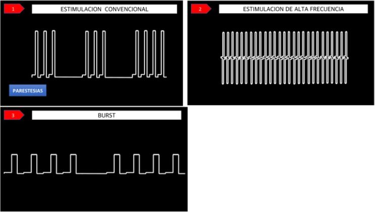 Ilustración de la variación en los sistemas de estimulación. Forma de las ondas eléctricas y del patrón de estimulación: 1) estimulación convencional (produce parestesias); 2) estimulación de alta frecuencia (no produce parestesias); 3) estimulación 
							Burst (no produce parestesias).
						