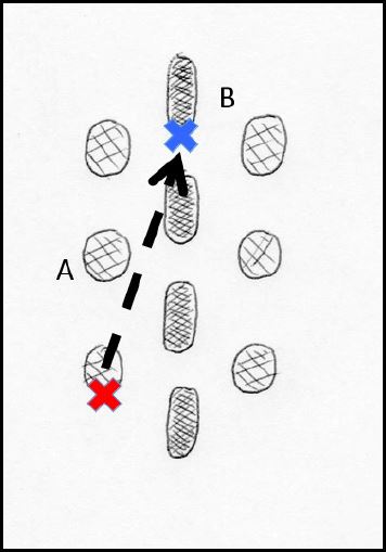 Técnica. Paso 1. Planeación. Con el paciente en una posición de decúbito prono y bajo visión fluoroscópica (rayos X) se identifican el borde inferior del pedículo seleccionado y se identifica el borde inferior de la apófisis espinosa dos vértebras superior. Estos dos puntos permiten direccionar la aguja. X roja: borde inferior de pedículo. X azul: borde inferior de la apófisis espinosa. A: pedículos. B: apófisis espinosa.
