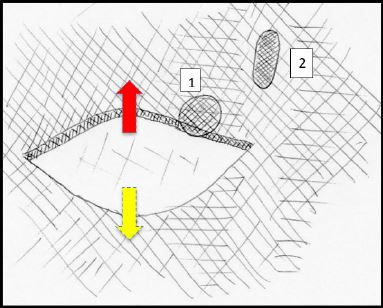 Técnica. Paso 2. Realización de la única (una sola) incisión que incluye: bolsillo generador de pulso + sitio de punción en el borde inferior del pedículo. Flecha roja: disección superior para realizar el bolsillo generador. Flecha amarilla: disección inferior para realizar el bolsillo generador. La incisión debe quedar sobre la línea correspondiente con los 2/3 del generador.