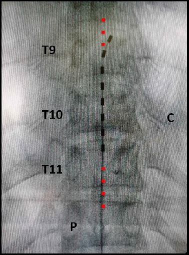 Técnica. Paso 3. Navegación epidural con el electrodo de estimulación. Radiografía AP (anteriposterior) donde se observa sobre la línea media un electrodo de estimulación de 8 contactos. Se observa un contacto inferior en el borde superior de T11 y un contacto superior en el borde superior de T9. C: costilla. P: pedículos. La línea roja ilustra la línea media.