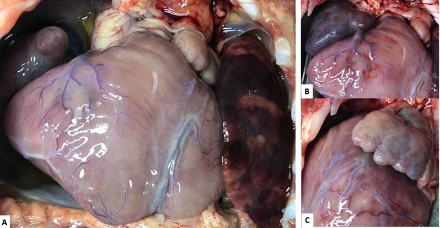 A) Mesocardio. B) Aur&iacute;cula derecha de base angosta, de morfolog&iacute;a izquierda. C) Aur&iacute;cula izquierda grande triangular, foleada, de morfolog&iacute;a derecha.