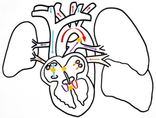 Diagrama de anomal&iacute;as cardiorrespiratorias. Rojo: flujo sist&eacute;mico arterial oxigenado; azul: flujo sist&eacute;mico venoso desoxigenado; naranja: flujo pulmonar oxigenado; violeta: flujo pulmonar desoxigenado; amarillo: cortocircuitos arteriovenosos.