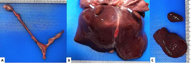 A) &Uacute;tero y anexo derecho dism&oacute;rfico. B) H&iacute;gado: l&oacute;bulos accesorios bilaterales (flechas). C) Poliesplenia.