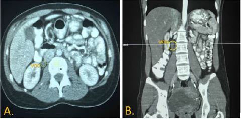 Tomograf&iacute;a computarizada contrastada abdominop&eacute;lvica de la paciente del caso. A) Corte transverso con dilataci&oacute;n e incremento del calibre de la vena ov&aacute;rica derecha (VOD) y ligero realce de la pared del vaso. B) Corte coronal con dilataci&oacute;n de la VOD y masa hipodensa central que corresponde a un trombo ocupante de la luz de la vena ov&aacute;rica
