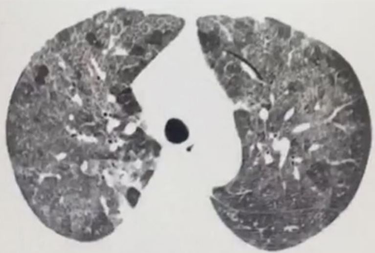 Tomograf&iacute;a computarizada de t&oacute;rax pretratamiento