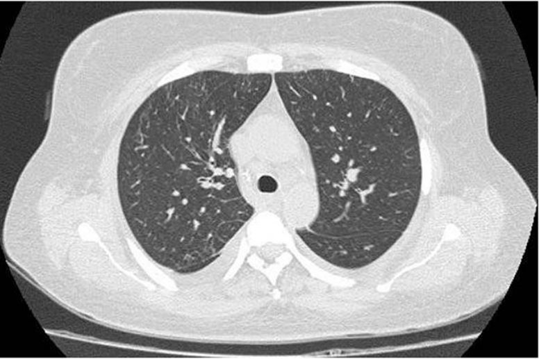 Tomograf&iacute;a computarizada de t&oacute;rax de control una semana postratamiento