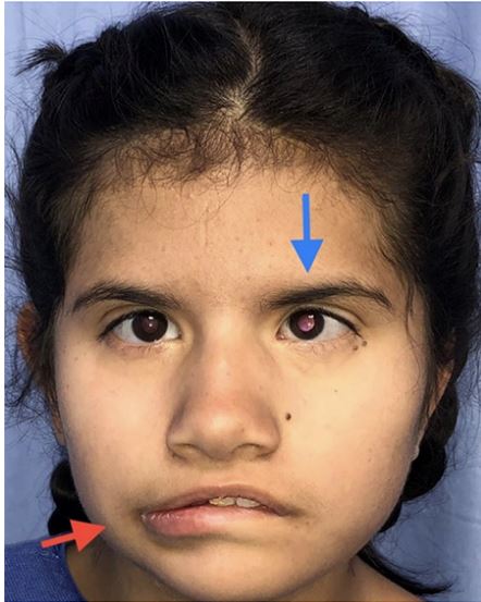 Aspecto de una niña con el síndrome de Möbius, quien presenta alteraciones oculares de estrabismo (flecha azul) e inexpresión facial, dada por la parálisis del nervio facial bilateral con descenso y desviación de la comisura labial (flecha roja). (Fotografía con autorización de la madre de la paciente para su publicación)