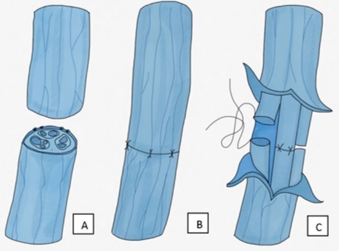 Tipos de neurorrafia primaria: a) lesi&oacute;n nerviosa, b) neurorrafia epineural, c) neurorrafia perineural (interfascicular)
