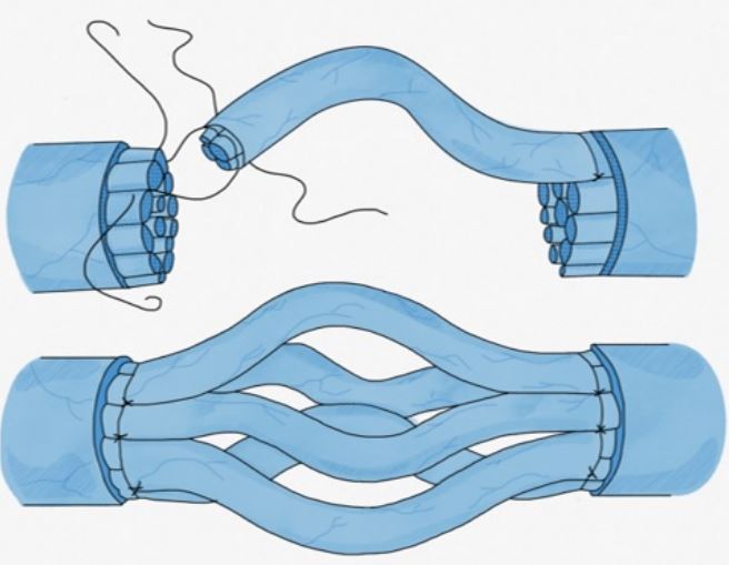 Injerto de nervio interfascicular. Se utilizan segmentos de nervio donante para llenar el espacio en el nervio lesionado