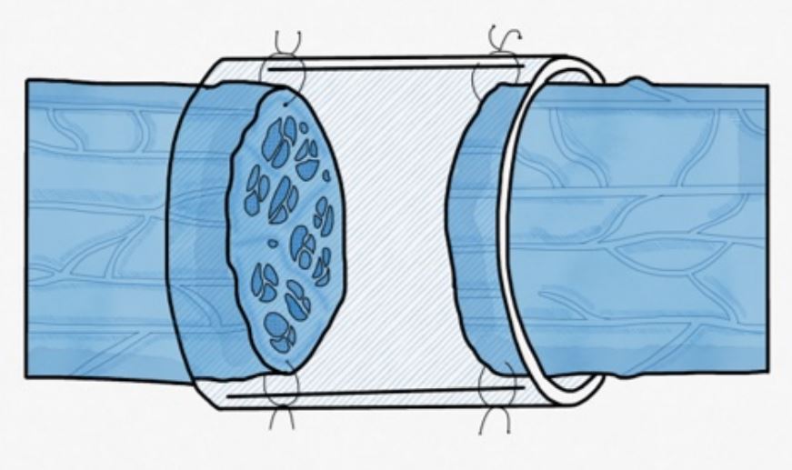 Tubos regenerativos que gu&iacute;an el crecimiento axonal hasta el cabo distal. Se han dise&ntilde;ado de diversos materiales biol&oacute;gicos y sinteticos. &Uacute;tiles para defectos de hasta 3 cm