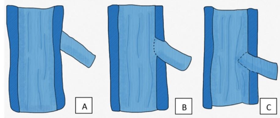 Diferentes formas de realizar anastomosis t&eacute;rmino-laterales. a) Epineuro intacto. b) Ventana de epineuro. c) Neurectom&iacute;a parcial