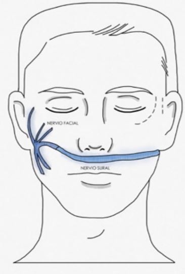 Injerto de nervio colocado entre ramas del nervio facial sano a ramas del nervio facial comprometido, con el fin de suministrar axones sanos al nervio facial lesionado