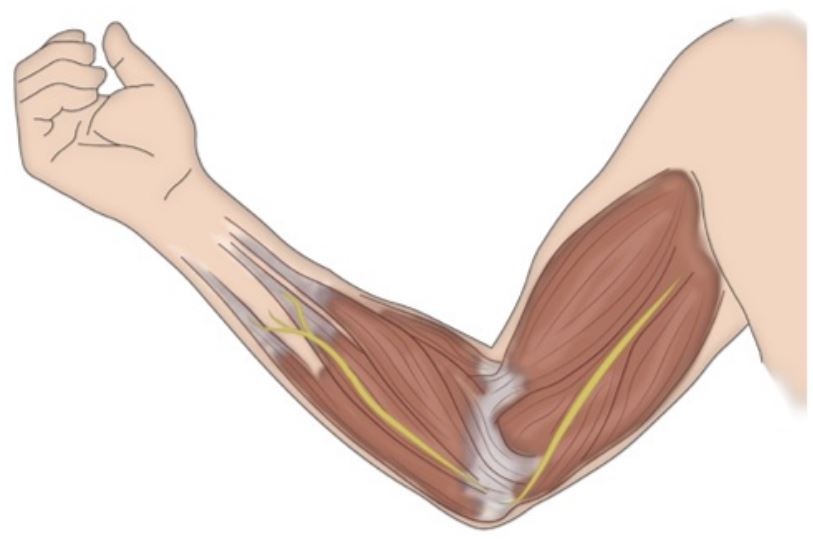 Neurotizaci&oacute;n muscular directa inserci&oacute;n de cabo distal de un nervio sano en un m&uacute;sculo denervado