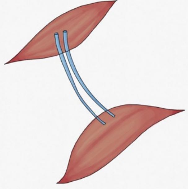 Neurotizaci&oacute;n m&uacute;sculonerviom&uacute;sculo Colocaci&oacute;n de un injerto nervioso que sirva de puente para que brotes axonales de un m&uacute;sculo sano lleguen al m&uacute;sculo denervado