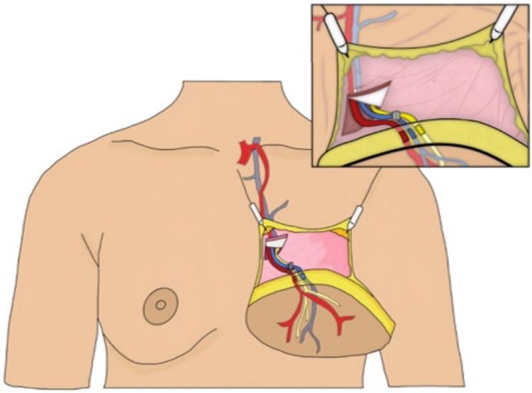 Neurotizaci&oacute;n cut&aacute;nea en reconstrucci&oacute;n de seno al realizar neurorrafia entre un nervio cut&aacute;neo incluido en el colgajo transferido y un nervio receptor intercostal
