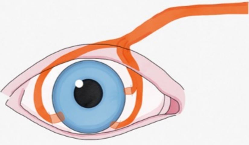 En la t&eacute;cnica de neurotizaci&oacute;n corneal los nervios supraorbitario o supratroclear se transfieren al &aacute;rea contralateral o ipsilateral en la superficie ocular y se fijan debajo de la conjuntiva
