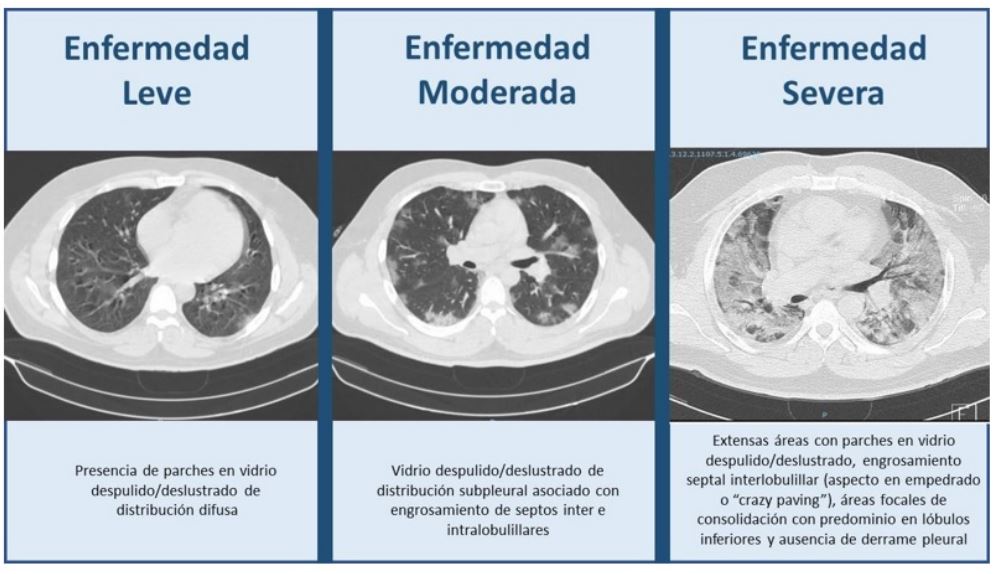 Hallazgos tomogr&aacute;ficos seg&uacute;n la clasificaci&oacute;n de gravedad de la enfermedad COVID19 (17)