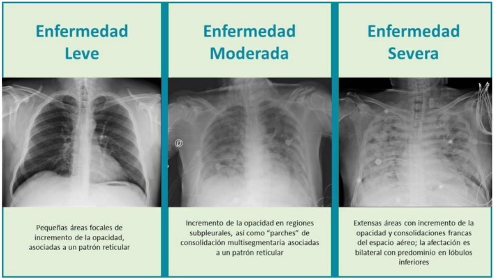 Hallazgos radiogr&aacute;ficos seg&uacute;n la clasificaci&oacute;n de gravedad de la enfermedad COVID-19 (17)