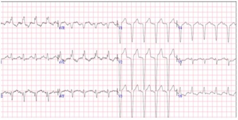 Electrocardiograma Se observa bloqueo completo de la rama izquierda