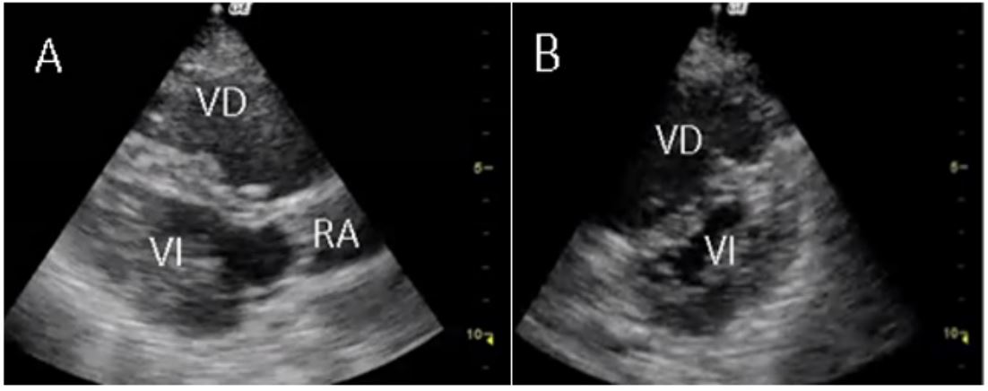 a) Eje paraesternal largo. Observe la dilataci&oacute;n del VD en comparaci&oacute;n con el VI. b) Eje paraesternal corto. Se evidencia sobrecarga de presi&oacute;n del VD sobre el VI, que cambia la forma del VI, que se conoce como signo de la D (D Sign)