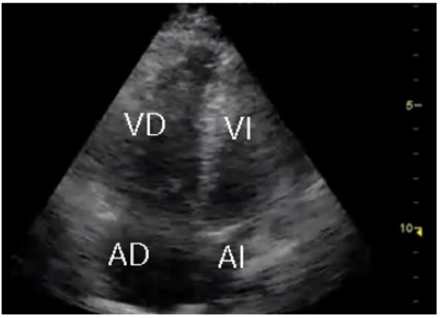 Eje apical de cuatro c&aacute;maras, donde se evidencia que la relaci&oacute;n entre el di&aacute;metro diast&oacute;lico del VD/di&aacute;metro diast&oacute;lico del VI es mayor a uno