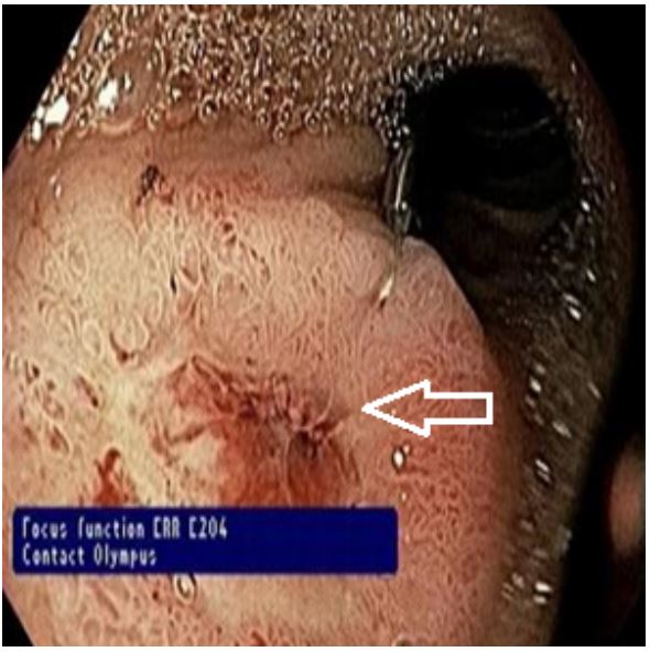 Endoscopia de las v&iacute;as digestivas altas. En la pared del codo duodenal se observa una &uacute;lcera de 12 mm, Forrest IIB. La flecha blanca indica la &uacute;lcera descrita