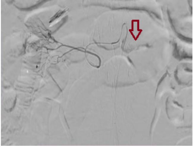 Arteriograf&iacute;a de los vasos abdominales. Luego de hacer un cateterismo de tronco cel&iacute;aco, se cateteriza la arteria gastroduodenal y se emboliza con micropart&iacute;culas de 300/500 micras. Luego se cateteriza la variante anat&oacute;mica del ramo duodenal directo del tronco cel&iacute;aco y tambi&eacute;n se emboliza con micropart&iacute;culas de la misma medida. En el control final se observa una disminuci&oacute;n del aporte arterial al sitio anat&oacute;mico donde se localiza la &uacute;lcera. La fecha roja indica el punto de extravasaci&oacute;n del aporte arterial a nivel de la &uacute;lcera