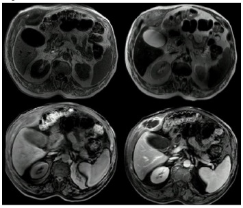 Resonancia magn&eacute;tica nuclear de abdomen. Imagen sugestiva de una masa dependiente del octavo, noveno y d&eacute;cimo arcos costales, hipointensa en T1 e hiperintensa en T2, de paredes gruesas y con tabiques en su interior con gadolinio. Infiltra los m&uacute;sculos intercostales y tiene invasi&oacute;n extraperitoneal con desplazamiento del segmento V hep&aacute;tico