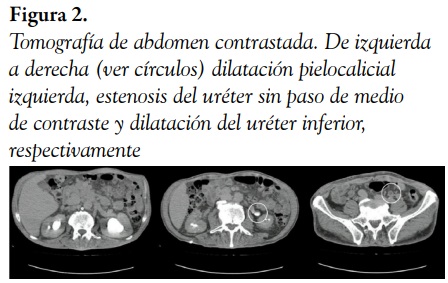 Tomograf&iacute;a de abdomen contrastada. De izquierda a derecha (ver c&iacute;rculos) dilataci&oacute;n pielocalicial izquierda, estenosis del ur&eacute;ter sin paso de medio de contraste y dilataci&oacute;n del ur&eacute;ter inferior, respectivamente