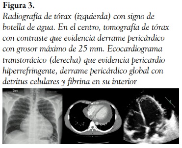 Radiograf&iacute;a de t&oacute;rax (izquierda) con signo de botella de agua. En el centro, tomograf&iacute;a de t&oacute;rax con contraste que evidencia derrame peric&aacute;rdico con grosor m&aacute;ximo de 25 mm. Ecocardiograma transtor&aacute;cico (derecha) que evidencia pericardio hiperrefringente, derrame peric&aacute;rdico global con detritus celulares y fibrina en su interior