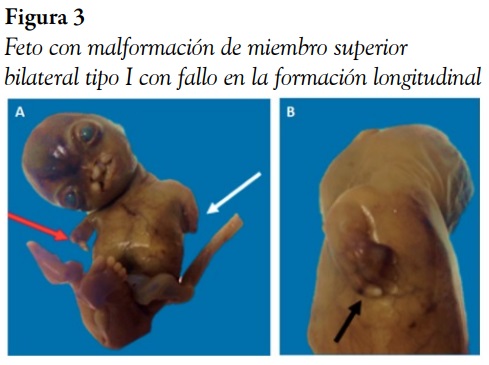 Feto con malformaci&oacute;n de miembro superior bilateral tipo I con fallo en la formaci&oacute;n longitudinal