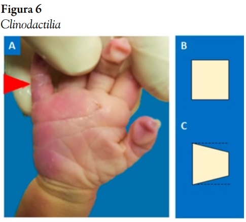 Clinodactilia